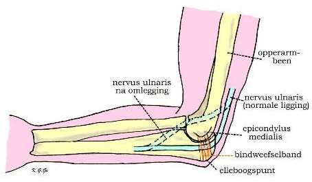 Il nervo ulnare è spesso compresso all'altezza del gomito a livello del canale cubitale. Le cause che possono portare ad una compressione del nervo ulnare sono diverse.