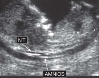 CLINICA- indagine ecografica Translucenza Nucale (NT) Misurazione dell area posta nella parte posteriore del collo del feto (11-13 +6 settimane di gestazione).