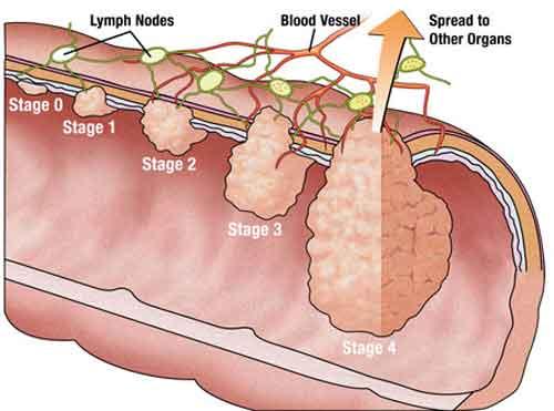 Tumore del colon retto E la seconda causa di morte per tumore in Italia.