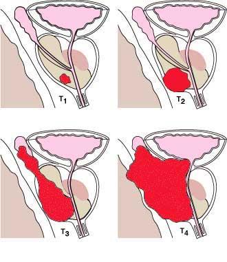 Tumore della prostata PSA antigene prostatico specifico una volta all anno nei soggetti tra 50 e 79 anni di età, insieme all'ecografia transrettale Il