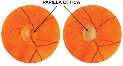 intraoculare (PIO) nel glaucoma.