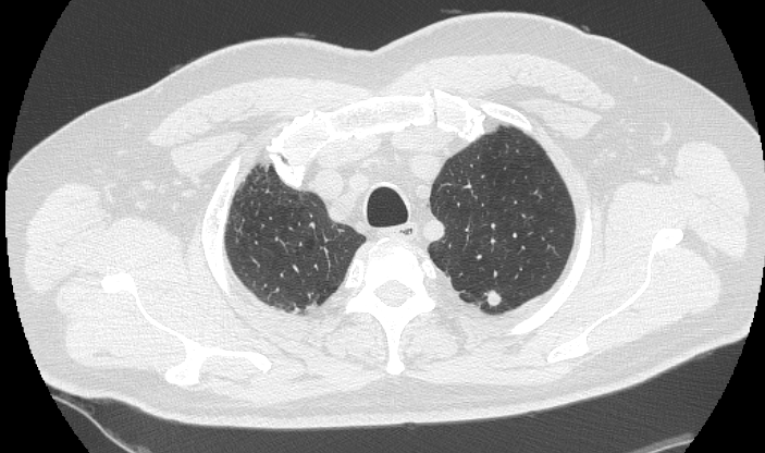 Tumore Oligometastatico: M1 polmonare controlaterale Nei pazienti con NSCLC e una localizzazione polmonare controlaterale, in assenza di metastasi mediastiniche