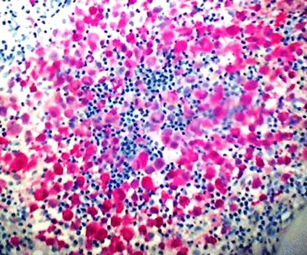 ) Istiocitosi X S-100 positive cells in a bone biopsy from a patient with an extrapulmonary localization of pulmonary