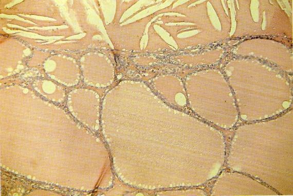 Tir 2 (THY2): Lesione citologicamente benigna In questo caso non sono necessari ulteriori studi diagnostici ma follow up ecografico ogni 6-18 mesi.