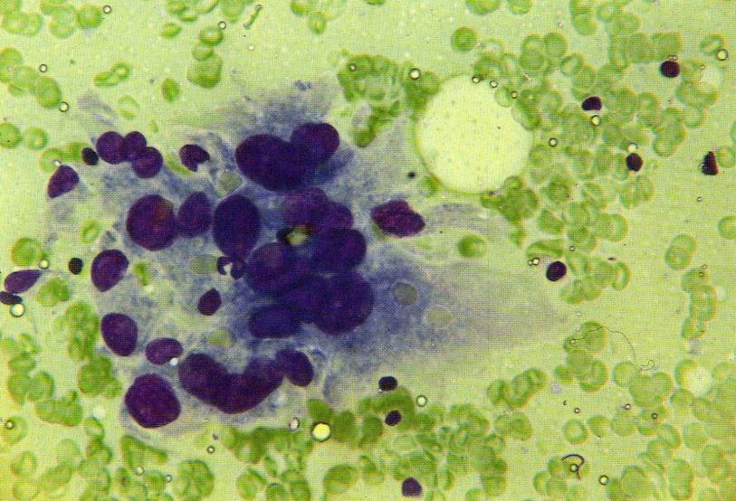 Tir 3 (THY3): CITOLOGIA INDETERMINATA: NEOPLASIA FOLLICOLARE NEOPLASIA A CELLULE DI HURTHLE Rischio di malignità 20-30% LESIONI FOLLICOLARI DI SIGNIFICATO INDETERMINATO Rischio di malignità 5-10% Al