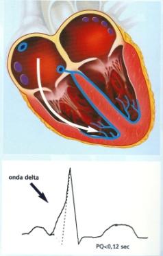 Modificazioni del QRS Durata Wolf Parkinson White (WPW) In rosso area delle possibile sedi di vie accessorie a Sedi principali dei fasci accessori 1.