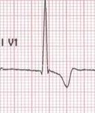 ST-T nelle precordiali destre onda T positiva V1-V2 sovraccarico ventricolare destro diastolico (volume) V1: BBDx tipo rsr con R >r Anomalie del tratto ST-T