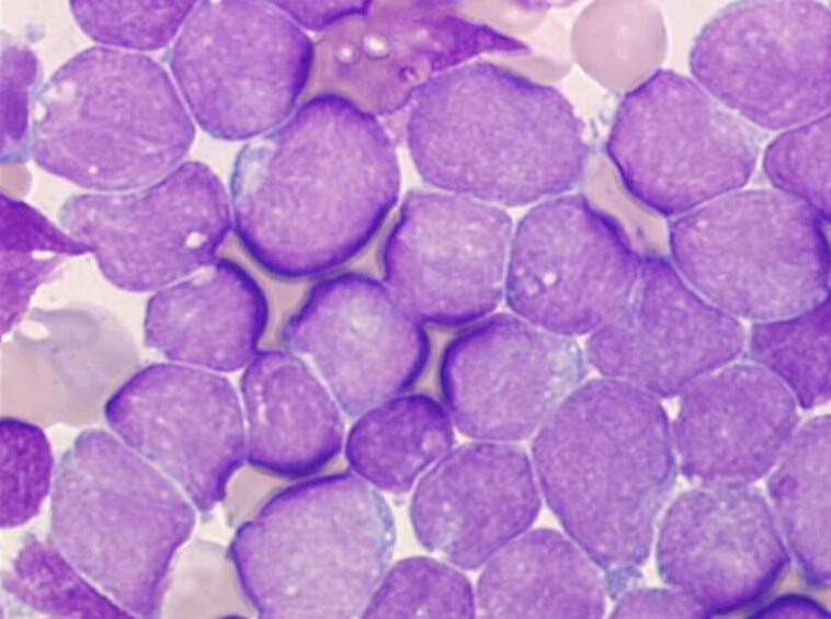 leukos emos = sangue bianco Malattia neoplastica dei tessuti emopoietici caratterizzati da: proliferazione neoplastica, clonale, automantenuta, dei tessuti linfoidi o mieloidi con un aumento