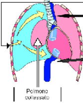 Spostamento della trachea che viene attirata dal lato del pneumotorace.