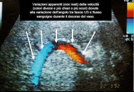 Eco-Color-Doppler All immagine B-mode viene sovrapposta una mappatura in scala cromatica delle velocità medie presenti in ciascun «frame» in cui il colore rappresenta la direzione del flusso e la