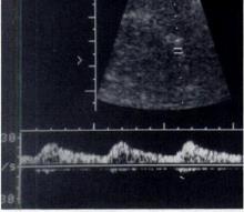 Acceleration Index (Handa 1986): Diagnostica US dell RVH a valle di una stenosi emodinamica la