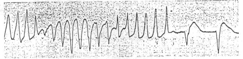 TORSIONE DI PUNTA Cicli di QRS con polarità alternante ventricologrammi slargati parossistici con R-R irregolari modificazione dell ampiezza QRS in ciascun ciclo F vn = 150-300 b/pm (in media