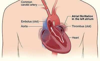 STROKE Terza causa di morte dopo le malattie cardiache 20 % degli stroke