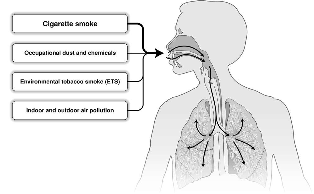 Risk Factors for COPD Nutrition Infections