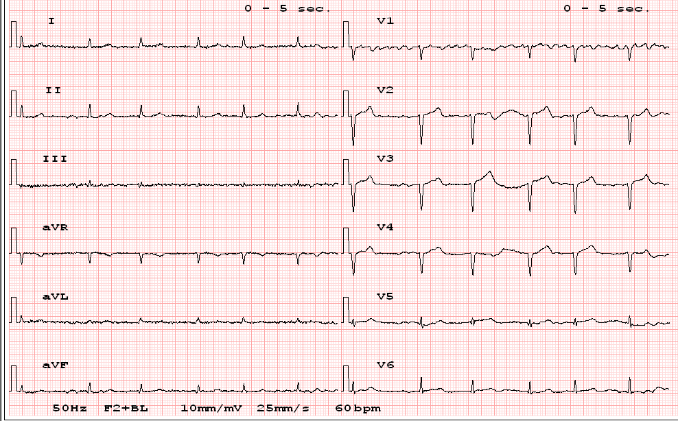 Alterazioni della conduzione; blocchi atrio ventricolari Analisi ECG Onda P Presenza Morfologia Frequenza Tratto PQ QRS