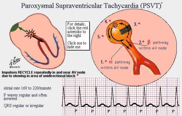 Onda P Presenza Analisi ECG Sì Ritmo sinusale/giunzionale No Fibrillazione atriale Flutter atriale Ritmo ventricolare Nel