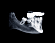 Puoi usare lo strumento trasparenza (8) per visualizzare le strutture anatomiche o gli impianti