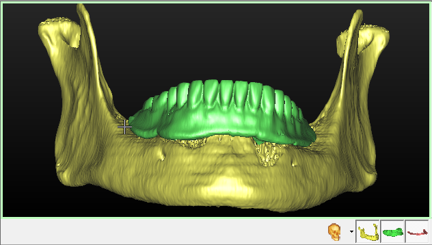 Ora è possibile regolare con precisione l oggetto 3D del tessuto molle, ruotando la protesi e attivando/disattivando la selezione.