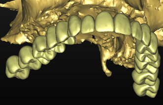 Quindi sposta il mouse verso l altro dente esterno, mantieni il tasto Maiusc premuto e clicca sul dente.