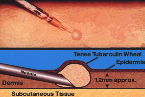 Latent TB and TST TUBERCULIN SKIN TEST Iniezione intradermica di 0,1 di derivato tubercolinico proteico purificato