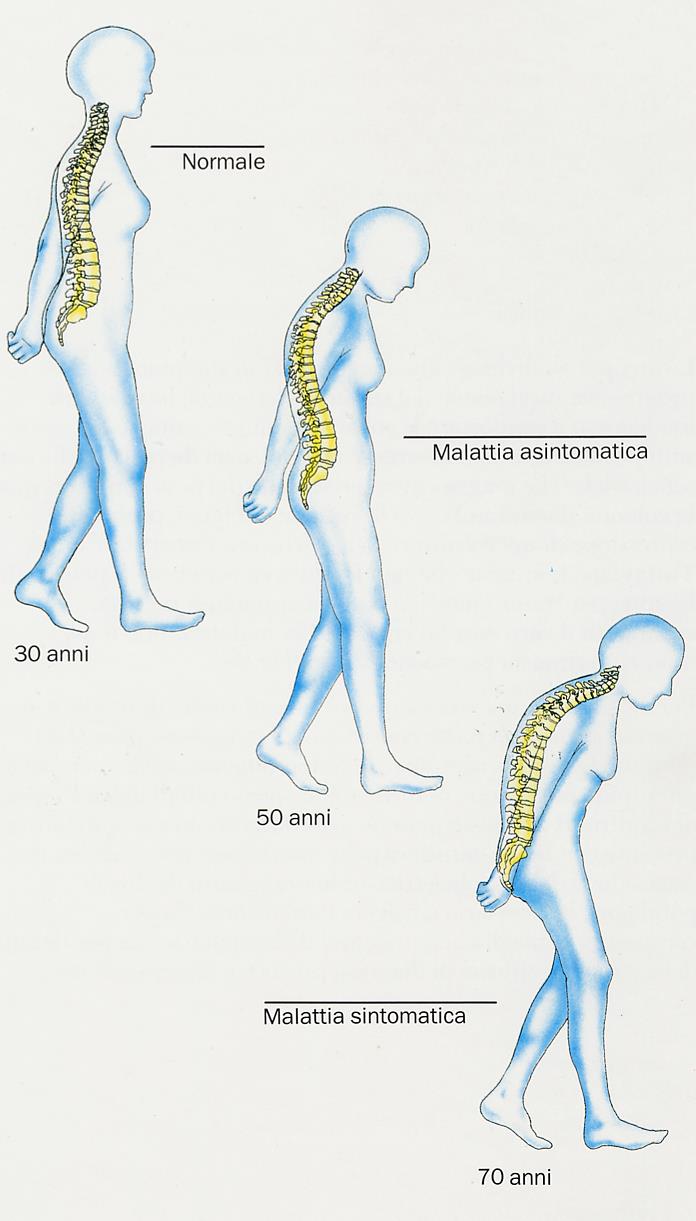 Osteoporosi: l epidemia