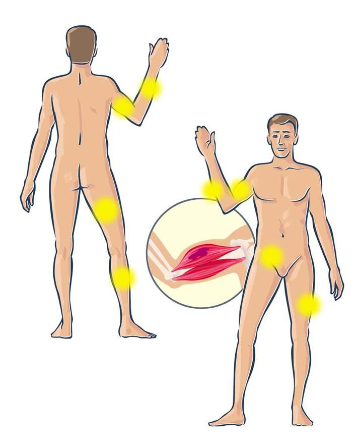 spesso colpiti sono quelli degli arti e il muscolo