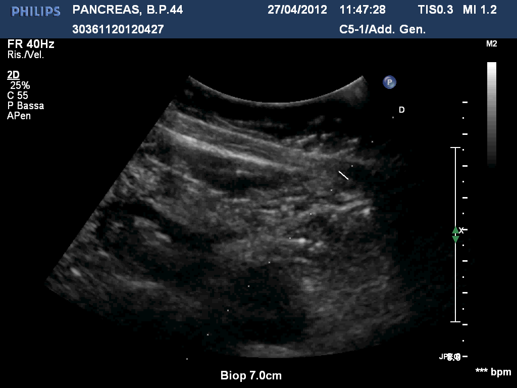 PANCREATITI CRONICHE FOCALI Nelle forme crooniche di lunga durata puo essere presente