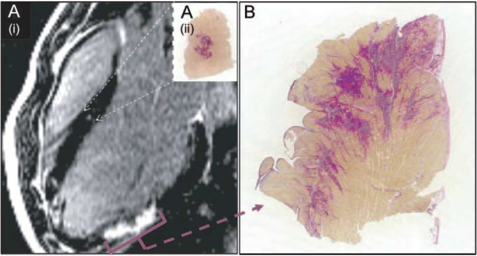 LVEDVi 160ml/m2; LVEF 40% MRI: