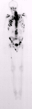 Medicina Nucleare Quali strumenti a disposizione Scintigrafia ossea (BS) SPECT e SPECT-CT La SPECT risolve il limite della scintigrafia ossea planare Le immagini acquisite sono multiplanari Consente