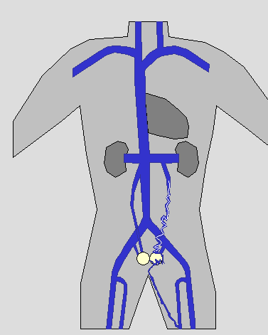 Figure 8. Disegno schematico di vene ovariche e pelviche dilatate Figure 9.