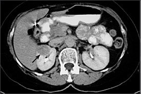 Attualmente sono noti cinque geni coinvolti nello sviluppo di tumori del rene ereditari. La sindrome che è stata per prima riconosciuta si chiama von Hippel- Lindau.