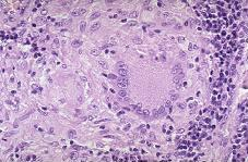 L infezione Lo sviluppo dell immunità specifica e l accumulo di macrofagi attivati porta alla formazione di un granuloma (tubercolo) nel sito della lesione primaria.