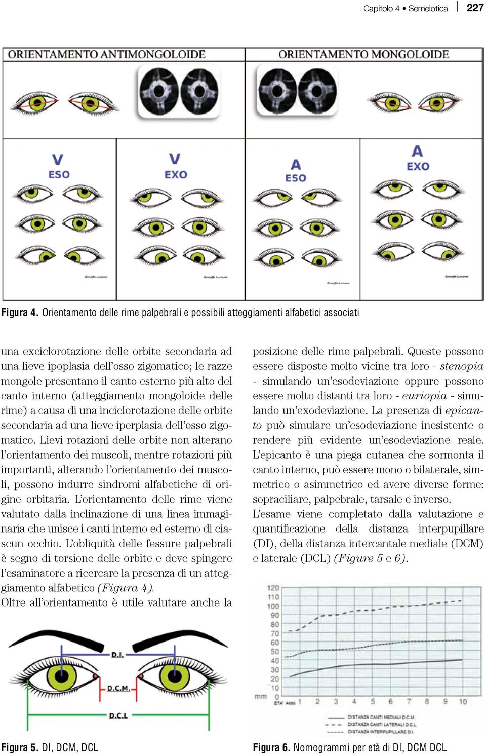 il canto esterno più alto del canto interno (atteggiamento mongoloide delle rime) a causa di una inciclorotazione delle orbite secondaria ad una lieve iperplasia dell osso zigomatico.