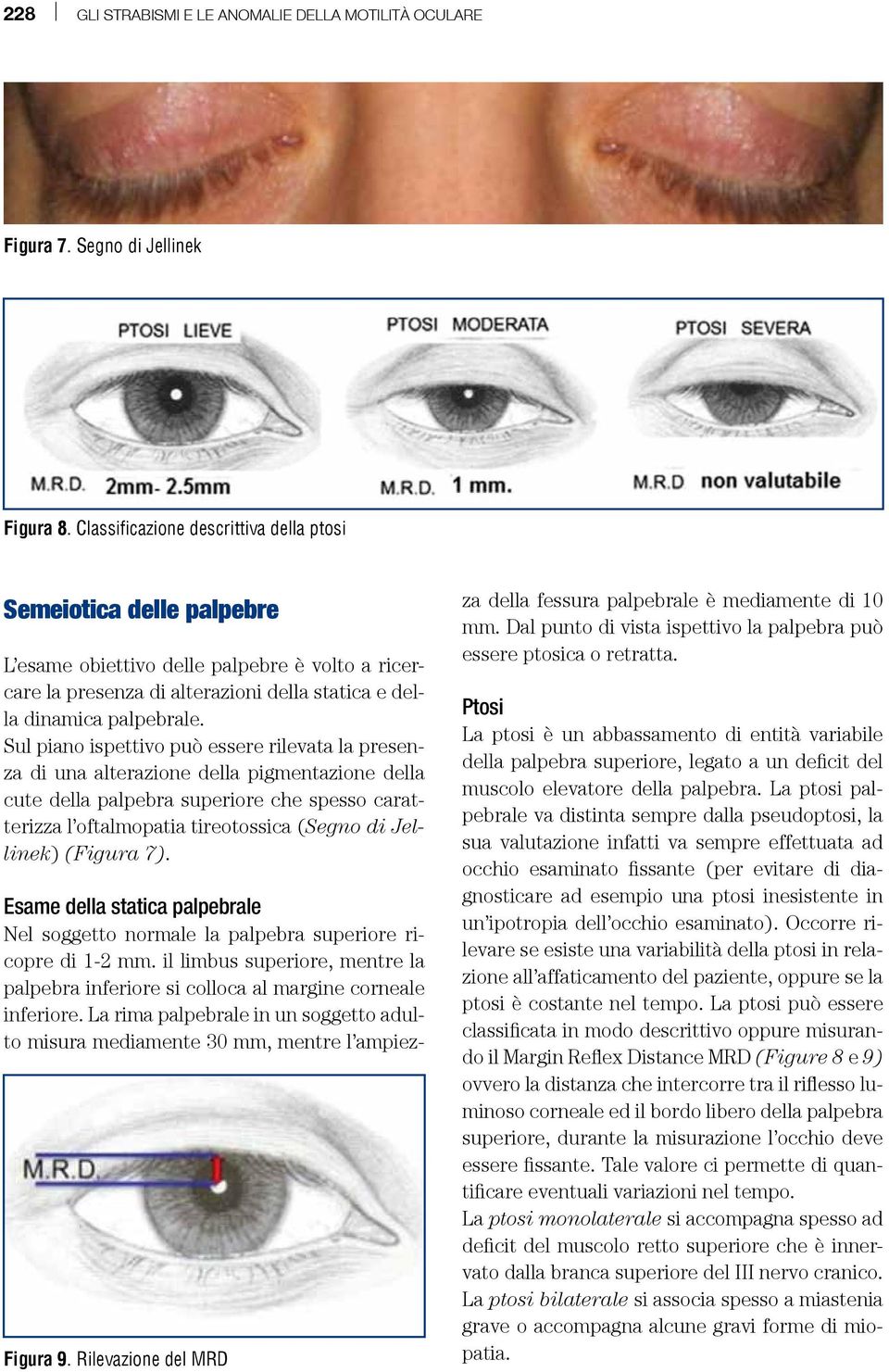 Sul piano ispettivo può essere rilevata la presenza di una alterazione della pigmentazione della cute della palpebra superiore che spesso caratterizza l oftalmopatia tireotossica (Segno di Jellinek)