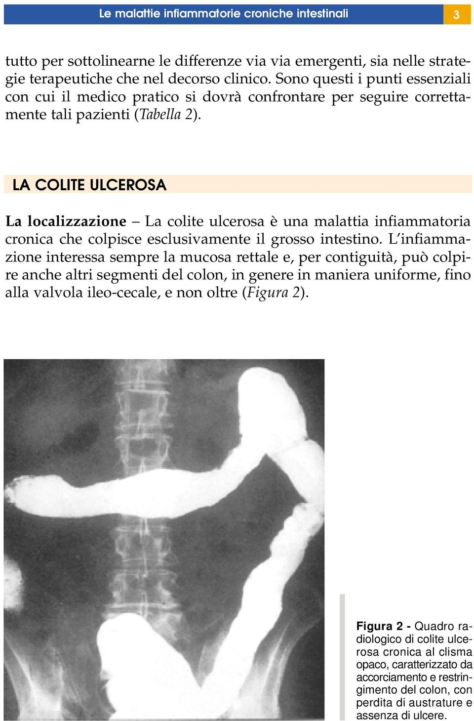 LA COLITE ULCEROSA La localizzazione La colite ulcerosa è una malattia infiammatoria cronica che colpisce esclusivamente il grosso intestino.