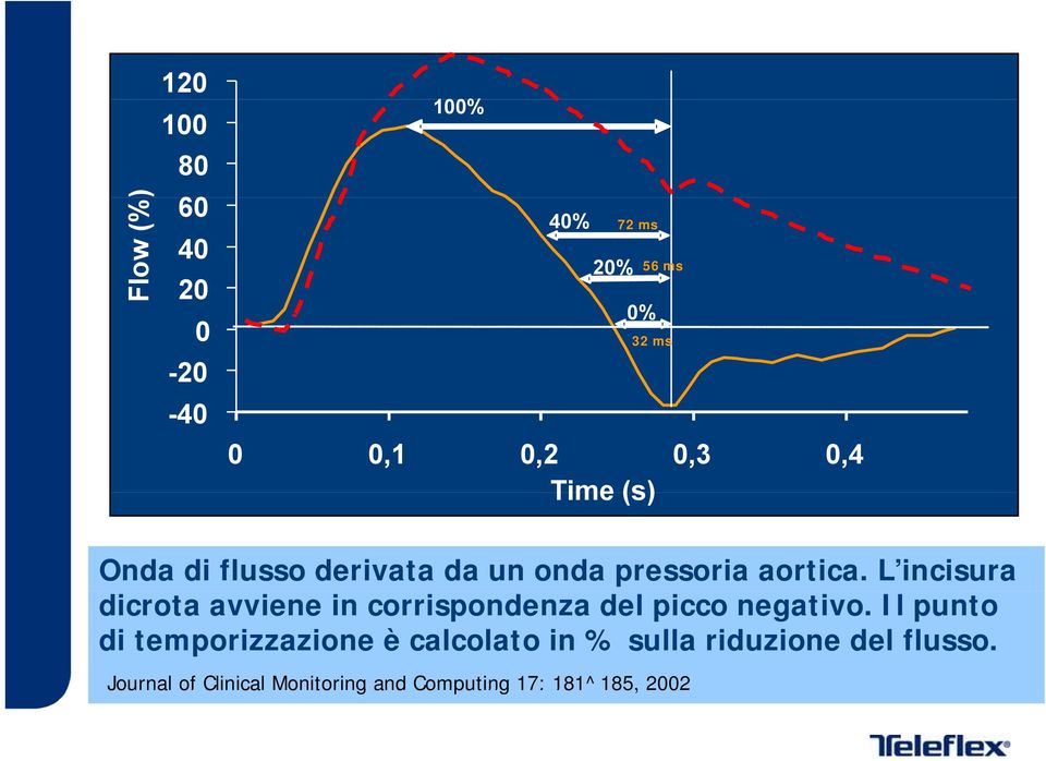 L incisura dicrota avviene in corrispondenza del picco negativo.