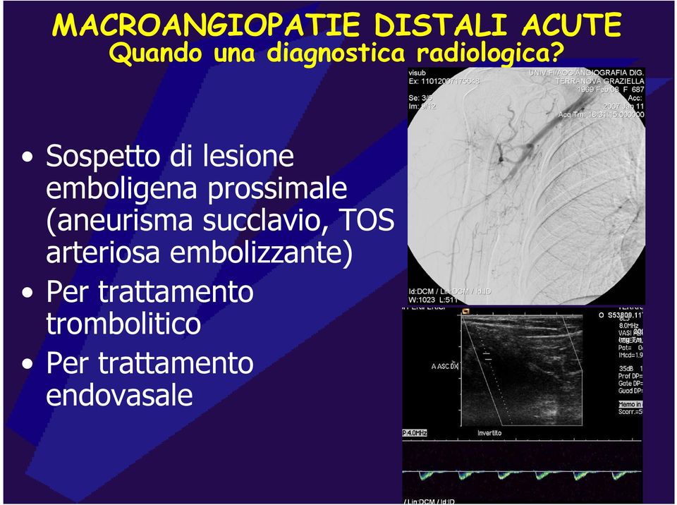 Sospetto di lesione emboligena prossimale (aneurisma