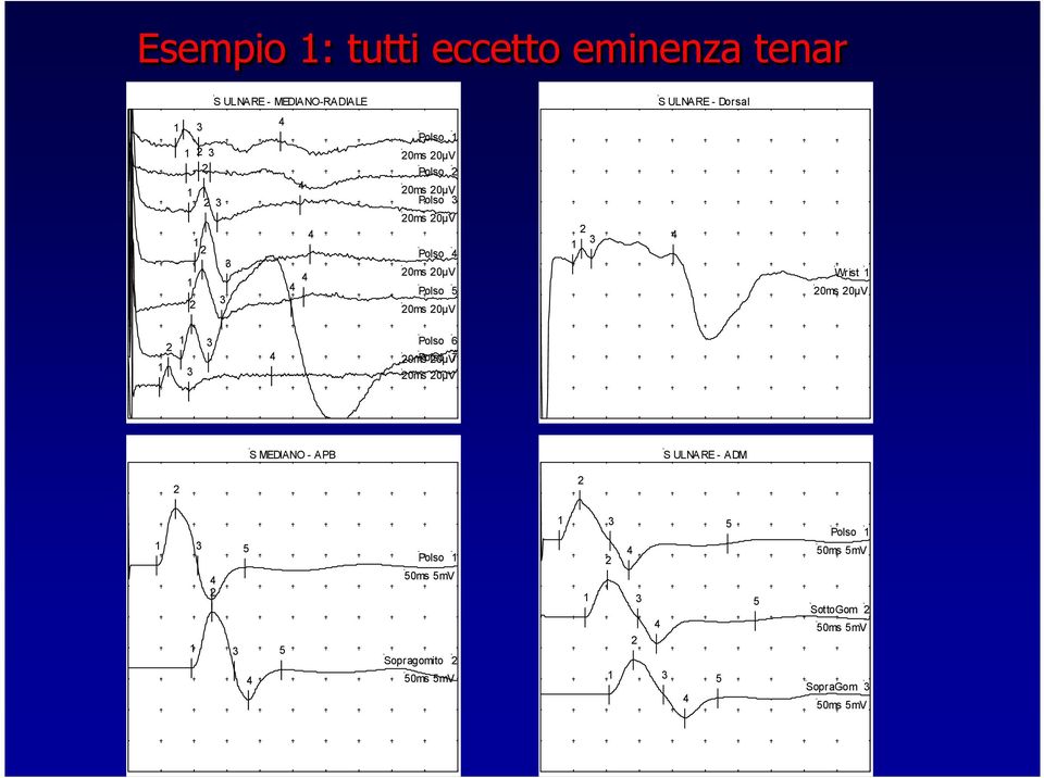 20ms 20µV 1 2 1 3 3 4 Polso 6 20ms Polso 20µV7 20ms 20µV S MEDIANO - APB S ULNARE - ADM 2 2 1 1 3 4 2 3 5 4 5 Polso