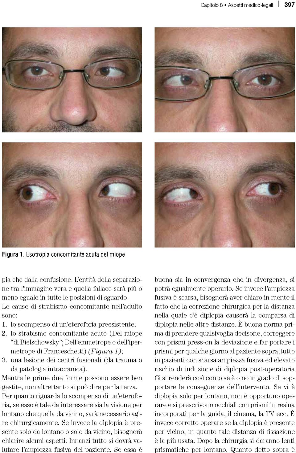 lo scompenso di un eteroforia preesistente; 2. lo strabismo concomitante acuto (Del miope di Bielschowsky ; Dell emmetrope o dell ipermetrope di Franceschetti) (Figura 1); 3.