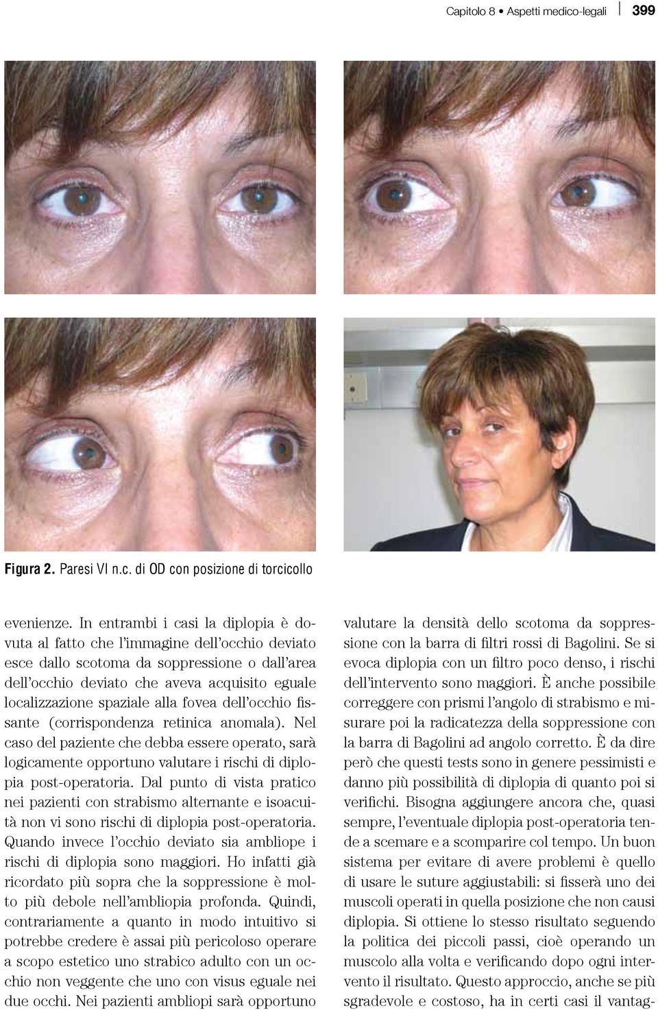 spaziale alla fovea dell occhio fissante (corrispondenza retinica anomala). Nel caso del paziente che debba essere operato, sarà logicamente opportuno valutare i rischi di diplopia post-operatoria.