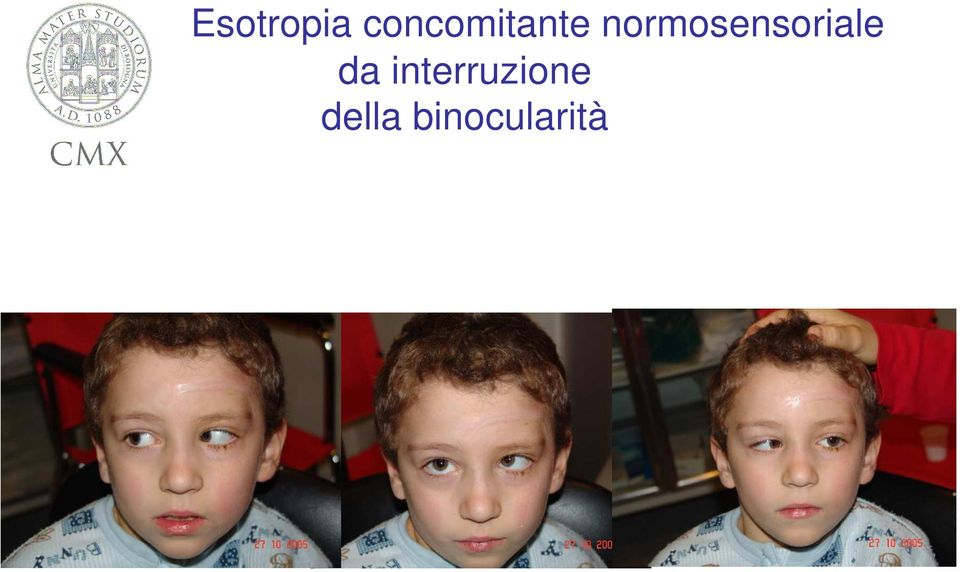 normosensoriale da