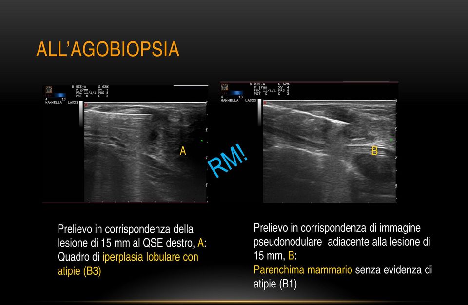 Prelievo in corrispondenza di immagine pseudonodulare adiacente