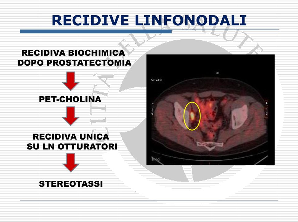 PROSTATECTOMIA PET-CHOLINA