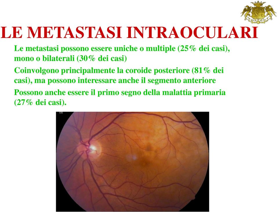 coroide posteriore (81% dei casi), ma possono interessare anche il segmento