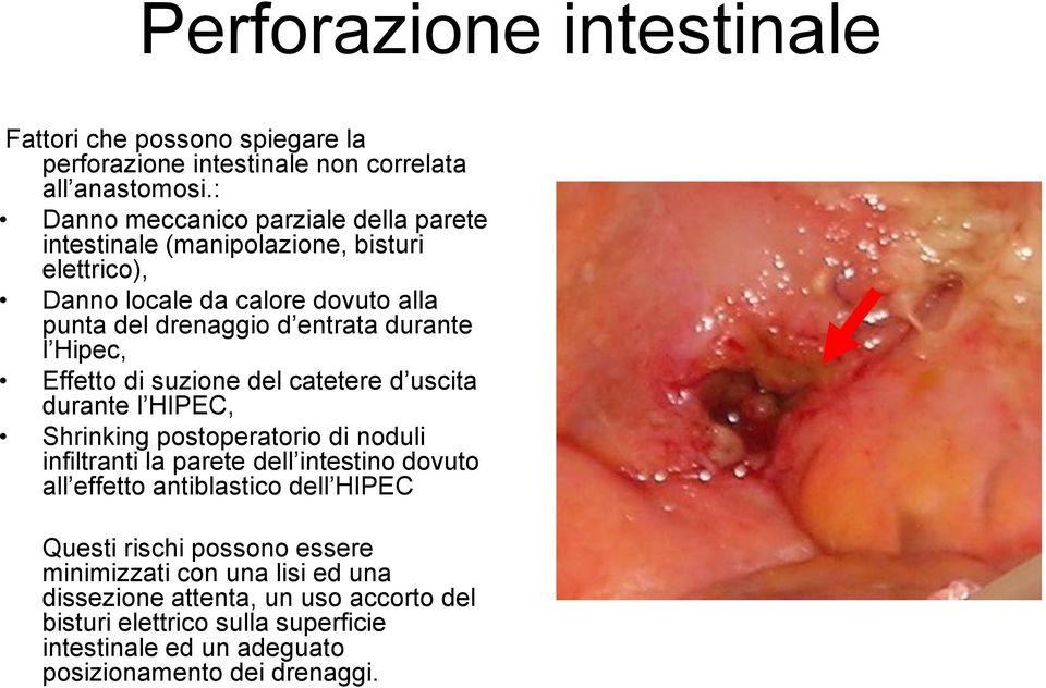 l Hipec, Effetto di suzione del catetere d uscita durante l HIPEC, Shrinking postoperatorio di noduli infiltranti la parete dell intestino dovuto all effetto