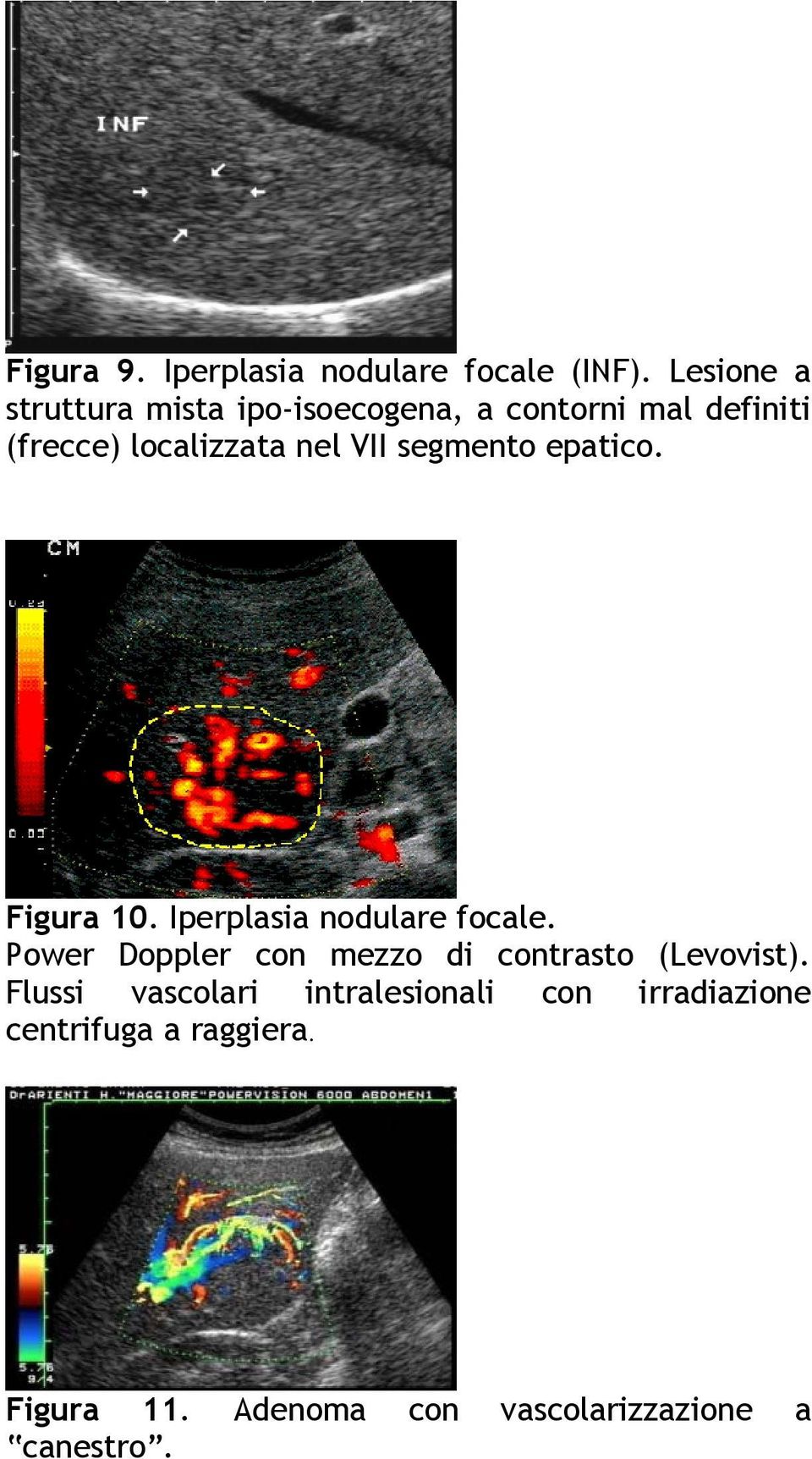 VII segmento epatico. Figura 10. Iperplasia nodulare focale.