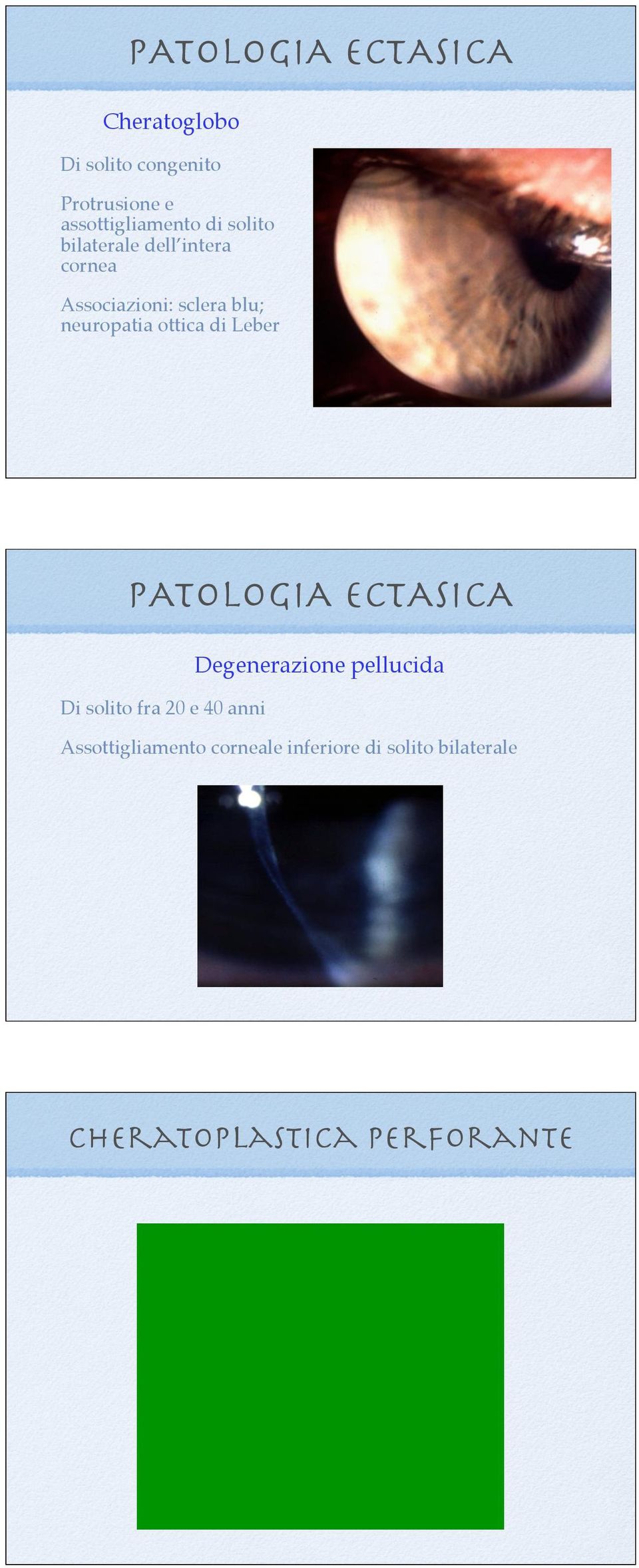 ottica di Leber PATOLOGIA ECTASICA Degenerazione pellucida Di solito fra 20 e 40