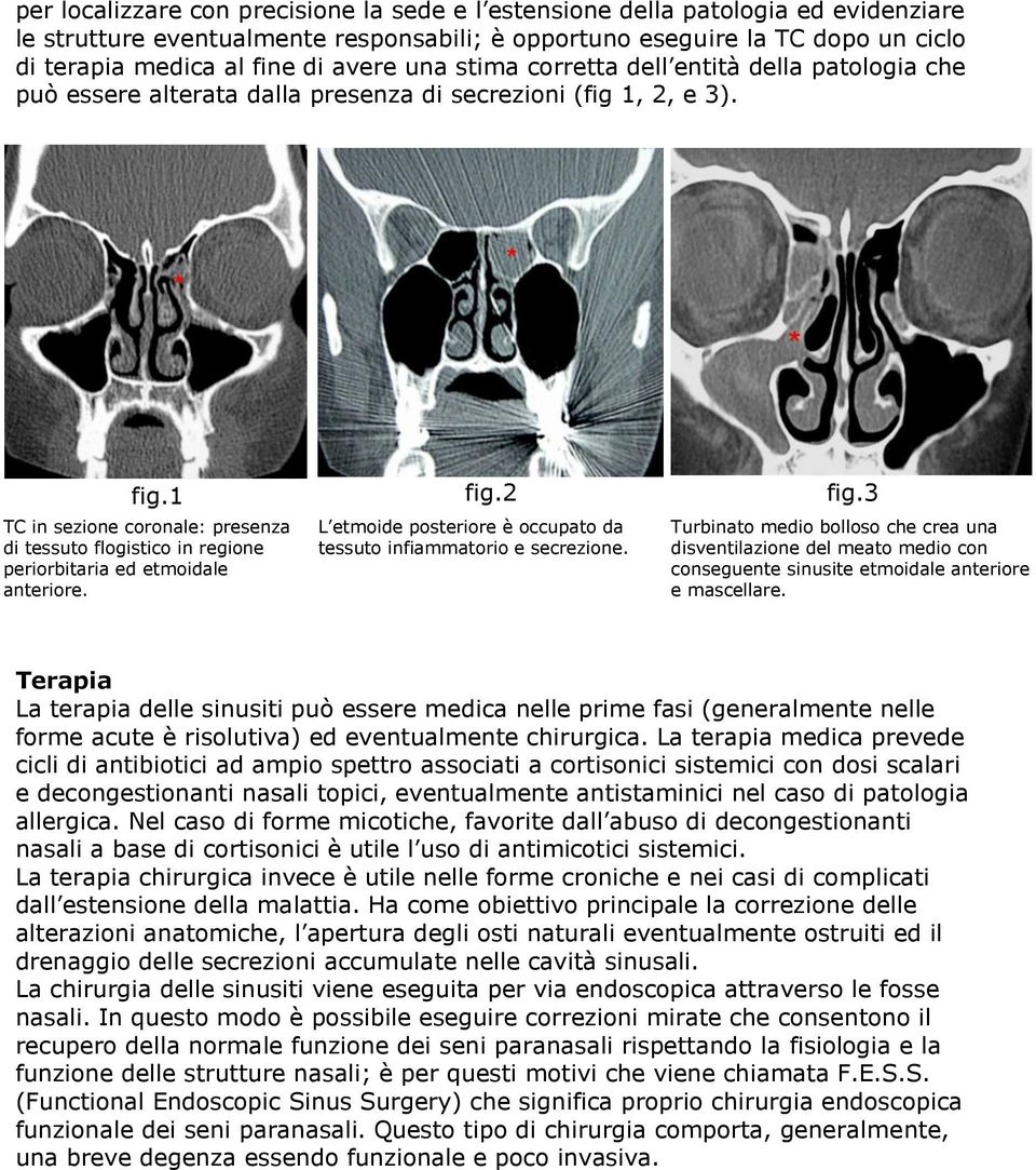 3 TC in sezione coronale: presenza di tessuto flogistico in regione periorbitaria ed etmoidale anteriore. L etmoide posteriore è occupato da tessuto infiammatorio e secrezione.