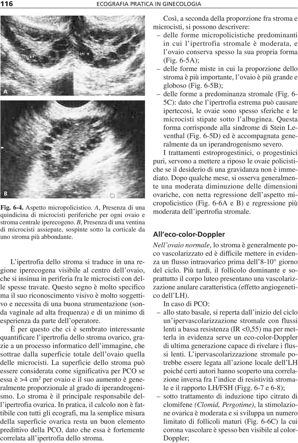 L ipertrofia dello stroma si traduce in una regione iperecogena visibile al centro dell ovaio, che si insinua in periferia fra le microcisti con delle spesse travate.