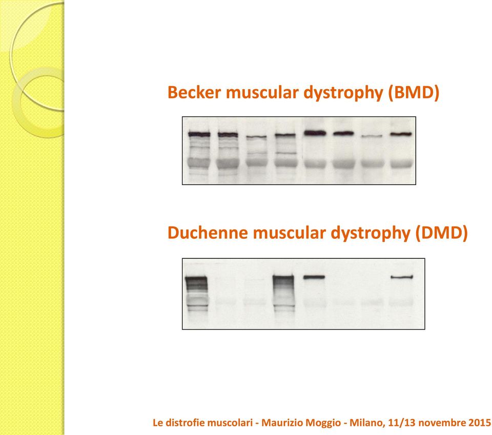Le distrofie muscolari - Maurizio